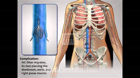 IVC Filter Complications - Medical Animation - YouTube