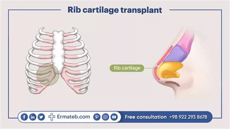 RIB Cartilage Rhinoplasty, How, Risks, Costs | Ermateb