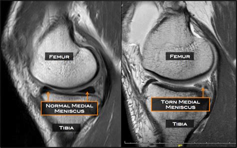 Meniscus Tear Austin, TX | ACL Injury Austin, TX | Knee Surgery Cedar Park