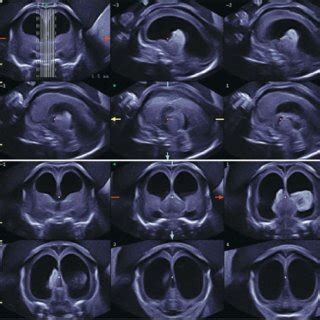 Spina Bifida Ultrasound 20 Weeks