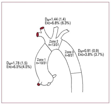 Intravascular Ultrasound Measurement of the Aortic Lumen | Revista Española de Cardiología