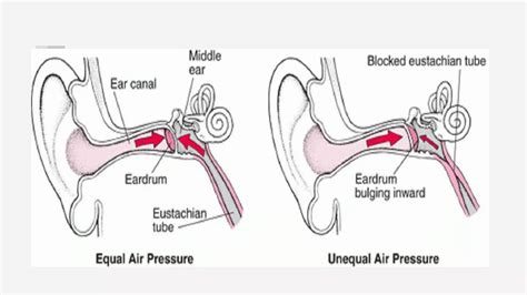 Ear barotrauma causes, symptoms and treatment | PPT