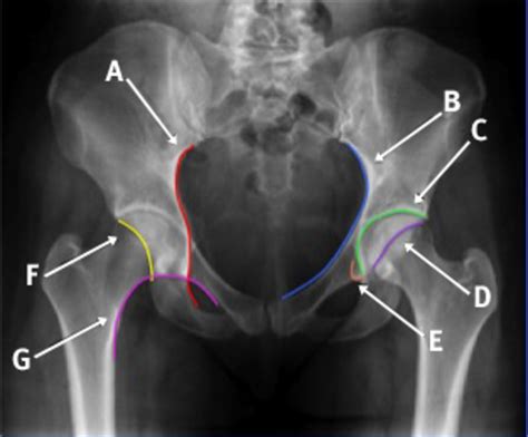 Ap Pelvis X Ray Anatomy