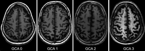 Fig. 11.3, [Global cortical atrophy scale. Illustration...]. - Diseases ...