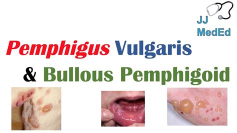 Vesiculobullous Skin Diseases | Pemphigus Vulgaris vs. Bullous Pemphigoid