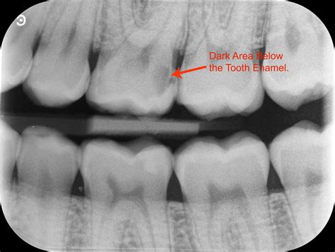 Tooth Cavity Xray