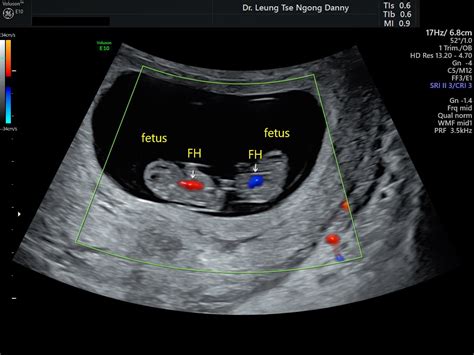 8 Week Ultrasound Fraternal Twins