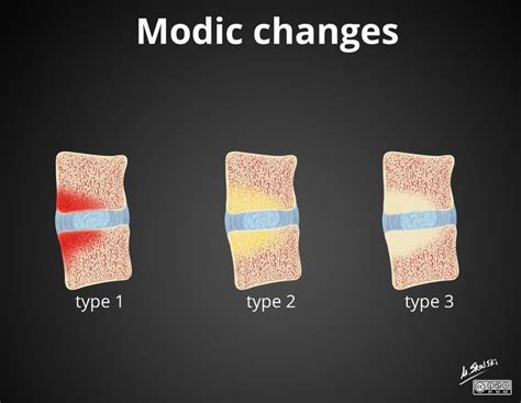 Modic-type endplate changes: diagram | Radiology Case | Radiopaedia.org ...