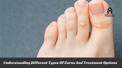 Understanding Different Types Of Corns And Treatment Options