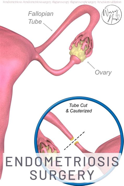 Endometriosis Surgery