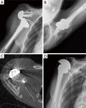 Managing acromial fractures: prevention and treatment, both ...