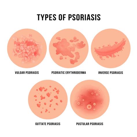 Cirrhosis Skin