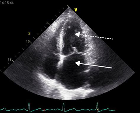 Echocardiogram Of Heart Failure