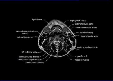 MRI neck anatomy | free MRI axial neck cross sectional anatomy | Vertebral artery, Anatomy ...