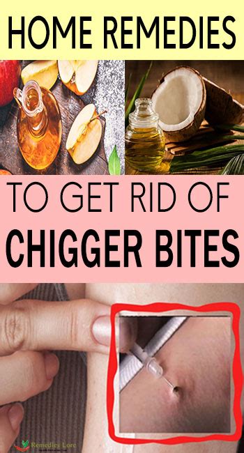 What Is The Treatment For Chigger Bites