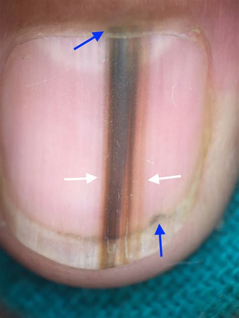 Longitudinal Melanonychia vs. Subungual Melanoma » Scary Symptoms