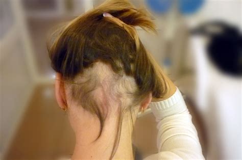 I was initially diagnosed with androgenic alopecia which is very hard to overcome to say the ...