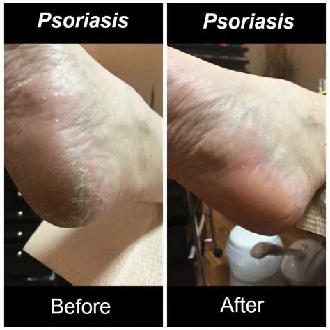 Psoriasis – Often Confused with Athlete’s Foot | Sole Purpose Foot Care