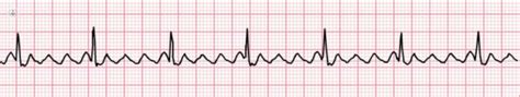 Identifying and Treating Atrial Flutter