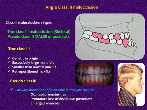 Classification of Malocclusion