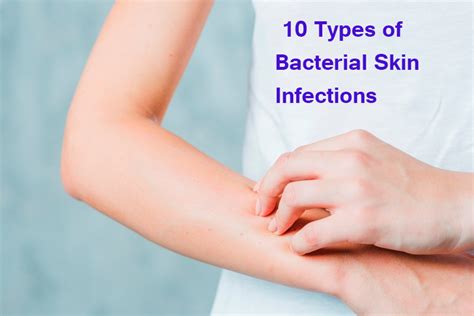 10 Types of Bacterial Skin Infections - Yabibo