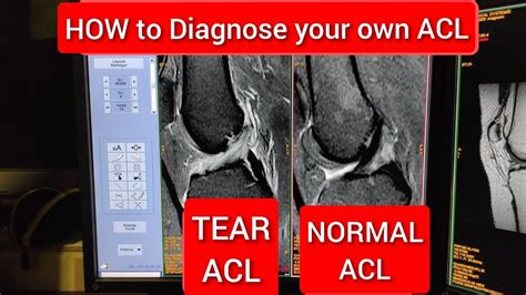 How to Diagnose your Own ACL Tear Anatomy on MRI. - YouTube