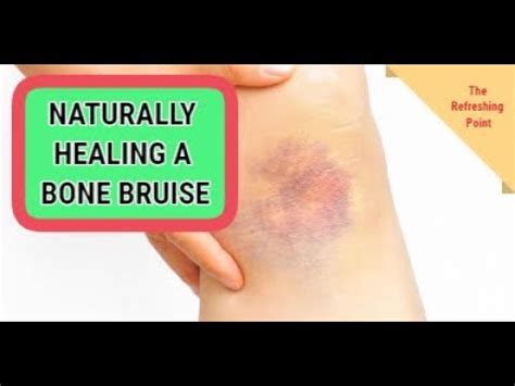 Bone Bruises - How to Identify Them and Healing Them Naturally - YouTube