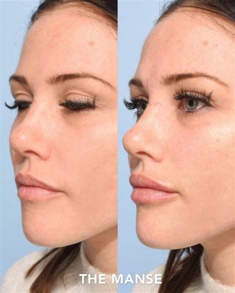 Subtle Cheek Fillers Before And After - All You Need Infos