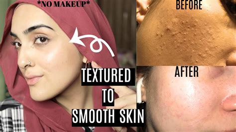 How To Get Rid of TEXTURED BUMPY SKIN & Get SMOOTH GLOWING SKIN | #Skincare Routine ~ Immy - YouTube