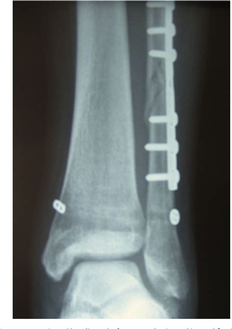 Table 2 from Tightrope fixation of ankle syndesmosis injuries: clinical outcome, complications ...