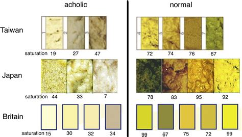 Biliary Atresia Stool Chart