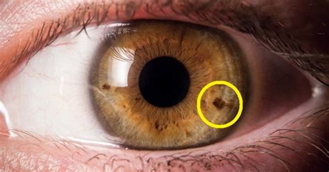 Do You Have a Spot on Your Iris? THIS is What it Means! - David Avocado ...