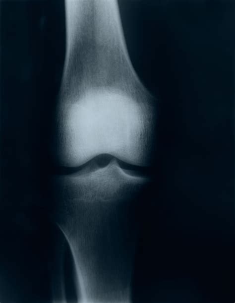 Imagen de rayos x de rodilla | Foto Premium