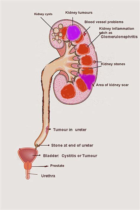 Haematuria (hematuria) – edren.org