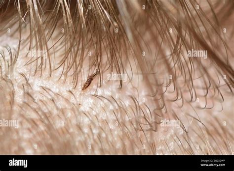 Dead lice in a child's hair after disinfection Stock Photo - Alamy