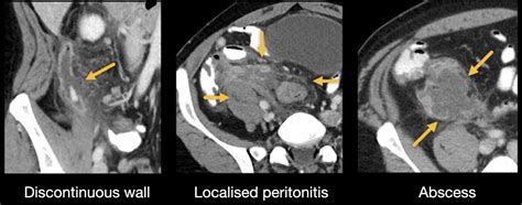 Abdominal CT: appendicitis • LITFL • Radiology Library