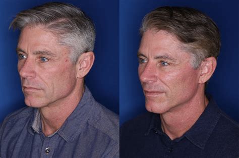 🥇 Atlanta Male Facelift Surgery | Buckhead Male Facelift Surgeon