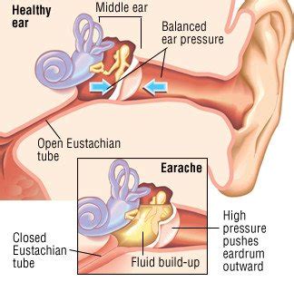 Earache Guide: Causes, Symptoms and Treatment Options