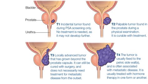 Metastatic Prostate Cancer: Why Is My Cancer Staged? - The Waiting Room