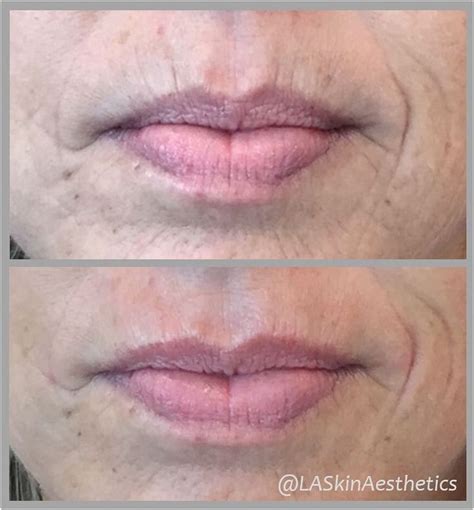 Smoker lines correction: One syringe of #Volbella was injected into ...