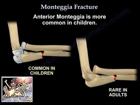 Galeazzi Monteggia | Spotlightmed Fracturas De Monteggia Vs Galeazzi ...