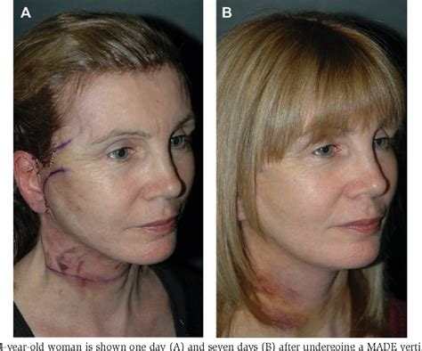 Figure 13 from Deep Plane Extended Vertical Facelift | Semantic Scholar