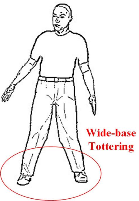 Frontiers | Clinical Recognition of Sensory Ataxia and Cerebellar Ataxia