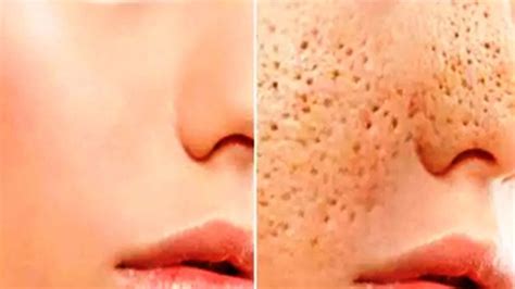 Large open Pores-Get Rid PERMANENTLY with simple Remedy - NAMAT blog