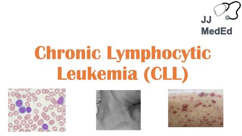 Chronic Lymphocytic Leukemia (CLL): Symptoms (ex. Skin Blisters), Diagnosis and Treatment (Vit D ...