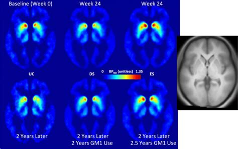 Positron emission tomography (PET) scanning of striatal dopamine... | Download Scientific Diagram