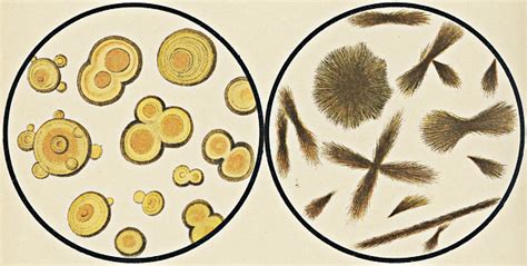 Microscopic View Of Leucine And Tyrosine Crystals From Urinary Sediment 19th Century Stock ...