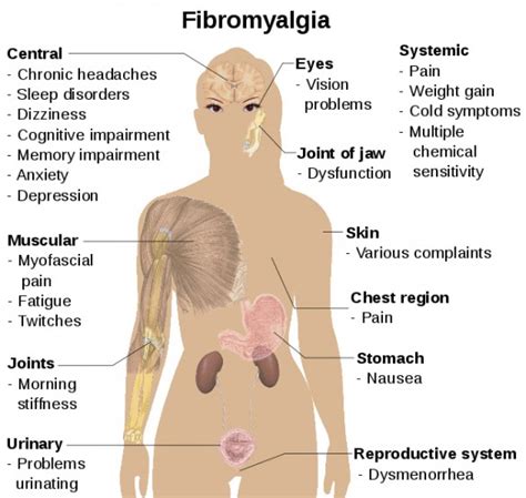 Fibromyalgia