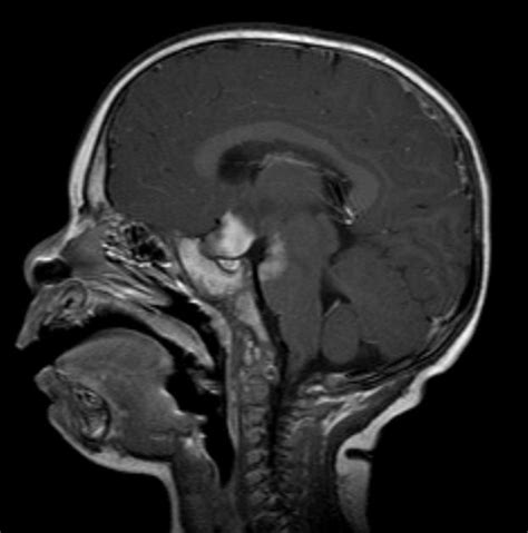 Optic nerve glioma MRI - wikidoc