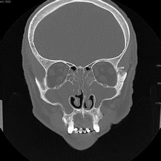 A coronal CT scan shows bilateral complete opacification of the ethmoid... | Download Scientific ...